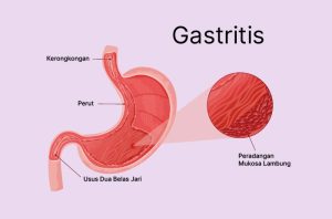 Apa Bahaya Gastritis Jika Dibiarkan Tanpa Pengobatan