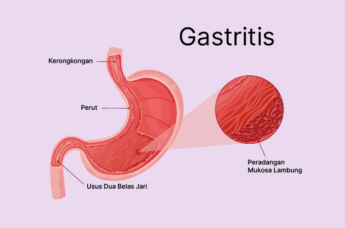 Apa Bahaya Gastritis Jika Dibiarkan Tanpa Pengobatan
