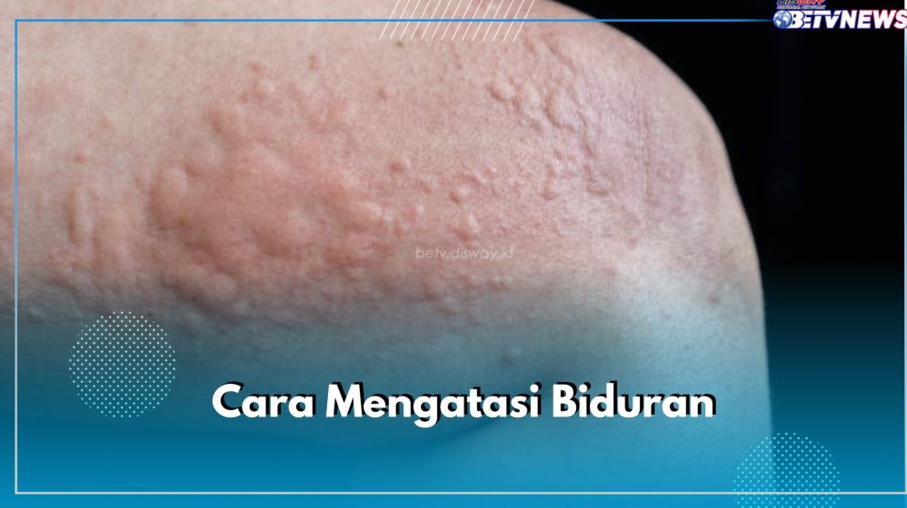 Apa Penyebab Biduran Yang Sering Kambuh