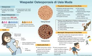 Apa Penyebab Osteoporosis Pada Usia Muda