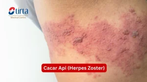 Apa Perbedahan Herpes Zoster Dan Cacar Air