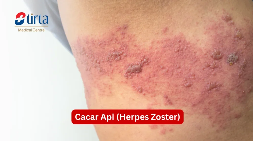 Apa Perbedahan Herpes Zoster Dan Cacar Air
