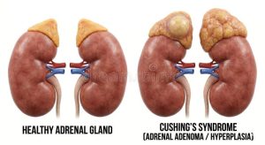 Apa Tanda Tanda Kelenjar Adrenal Bermasalah Cushing Syndrome
