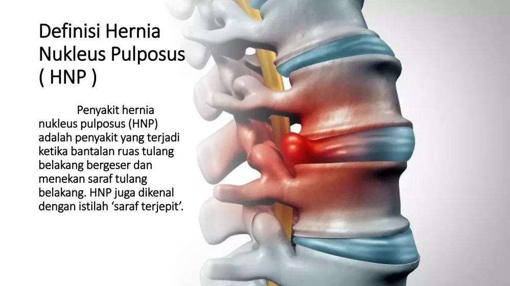 Bagaimana Cara Merawat Tulang Belakang Yang Bengkak Hernia Nukleus Pulposus