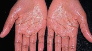 Kenapa Tangan Dan Kaki Sering Berkeringat Dingin