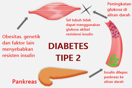 Mengapa Usia Muda Bisa Terkena Diabetes Tipe 2 Kenali Penyebab Gejala Dan Pencegahannya